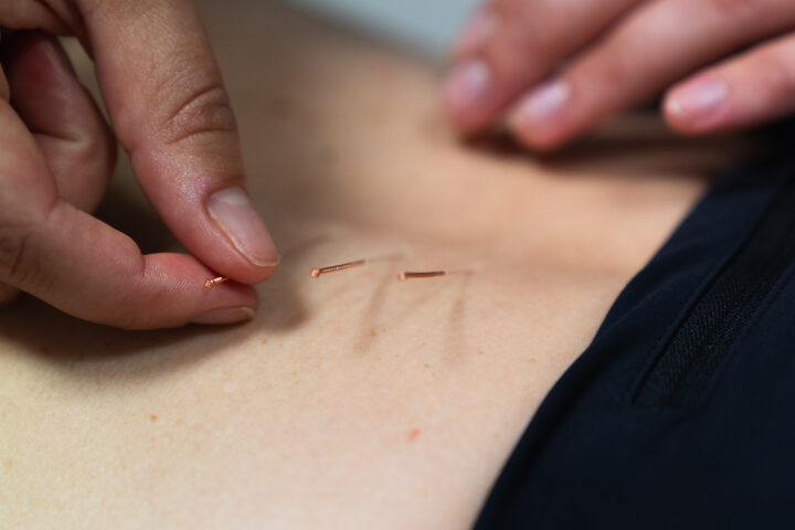 Acupuncture & Dry Needling